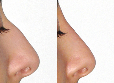 Rhinoplastie médicale acide hyaluronique mellul lille 