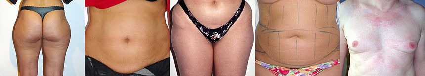 De bons cas pour la lipoaspiration