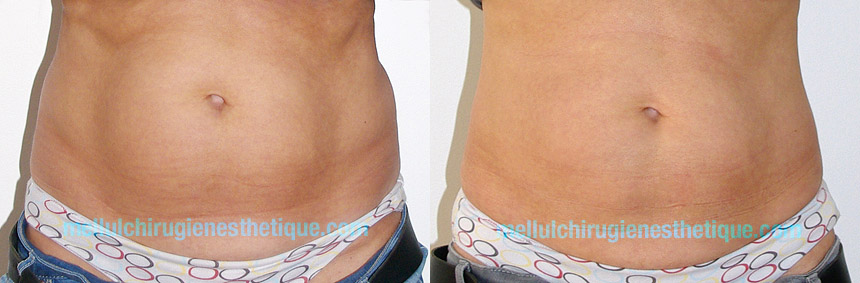 Cryolipolyse-cristal-mellul-ventre