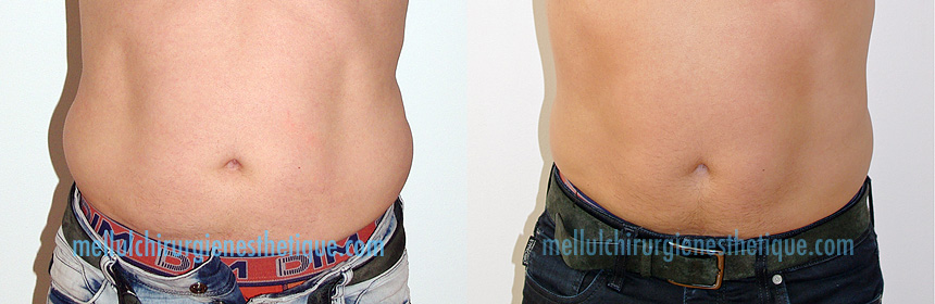 Résultat après 2 séances de cryolipolyse cristal des poignées d'amour chez l'homme