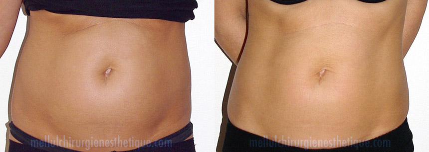 Cryolipolyse-cristal-mellul-ventre2